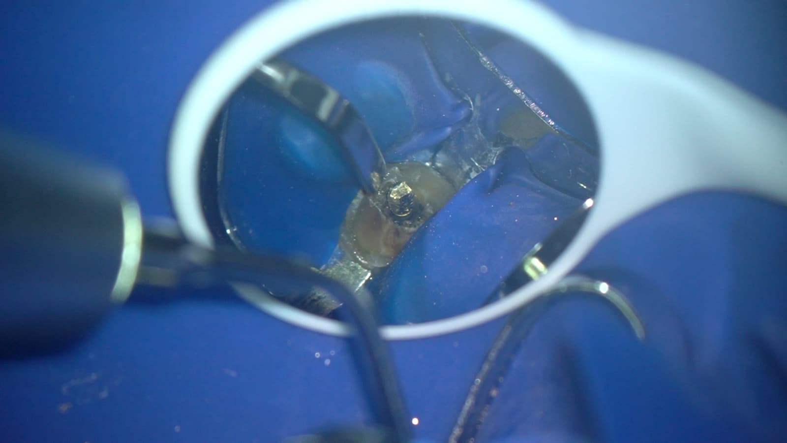 Remoción de un instrumento fracturado dentro del diente, vista a través del microscopio