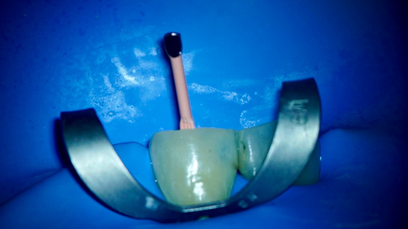 Diente aislado con dique de goma azul durante un tratamiento de conducto